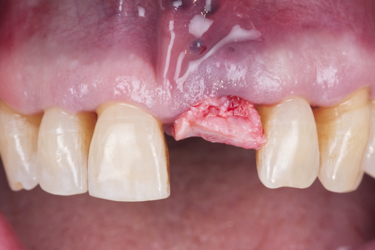 Afterwork Chasles – L'IDR : Reconstruction Alvéolaire Innovante Mardi 17 Juin 2025 – Avec le Dr P. KHAYAT