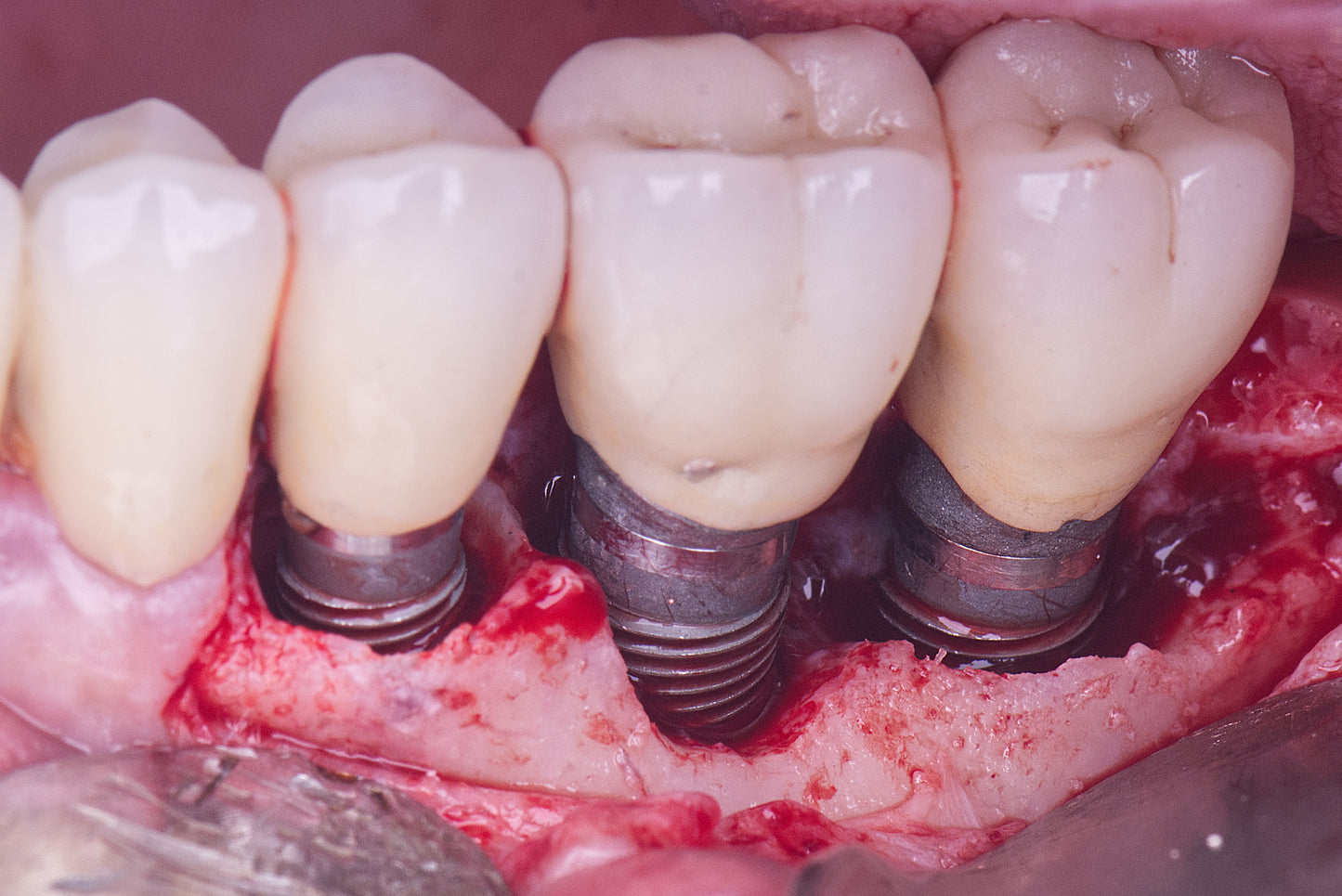 Afterwork Chasles – Péri-Implantites : Risques & Traitements Modernes Mardi 9 Décembre 2025 – Avec le Dr F. CHAMIEH